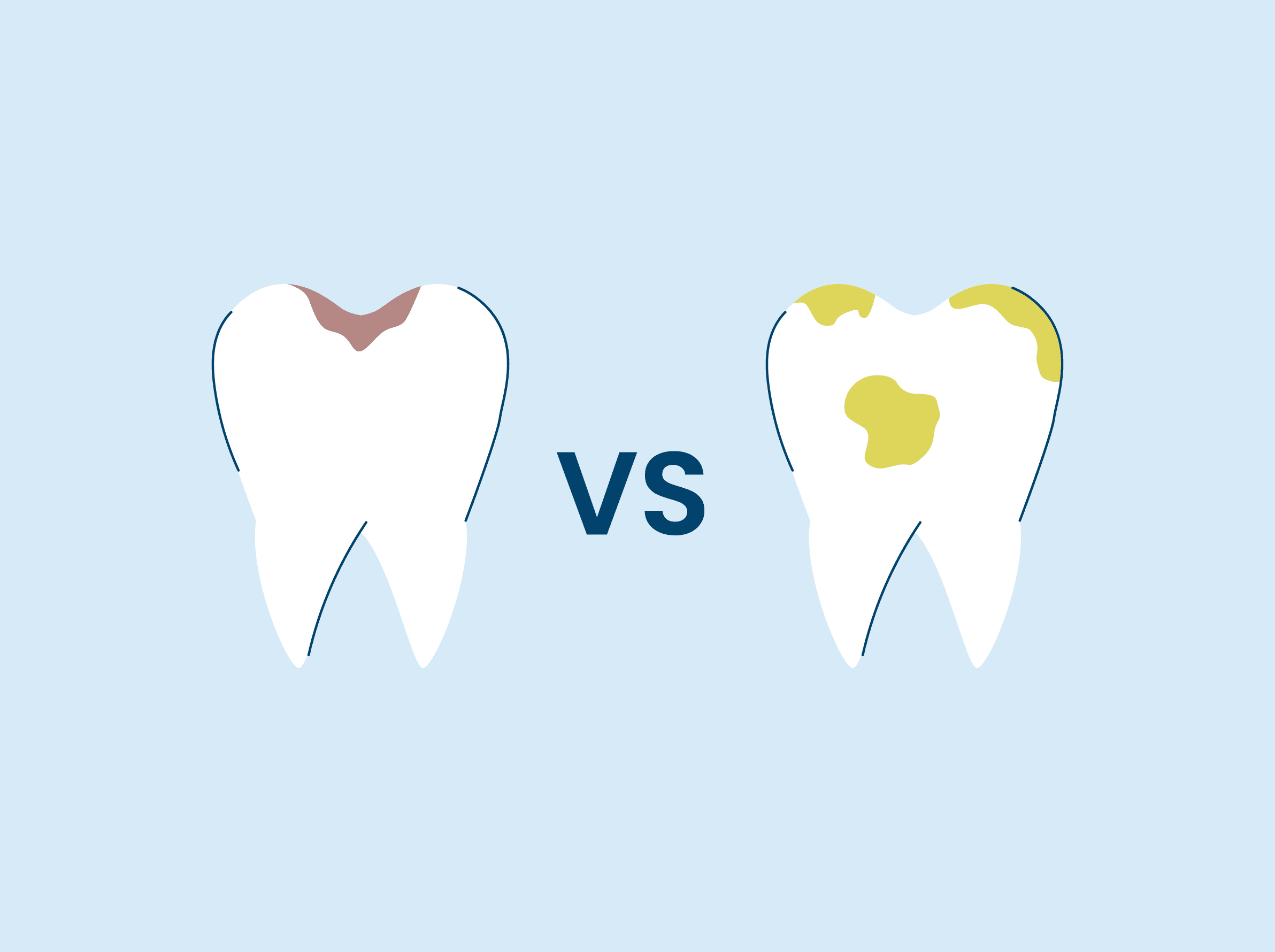 Cavity vs. Stain How to Tell the Difference