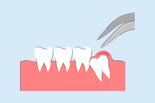 emergency wisdom tooth removal process - everything you need to know