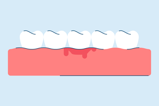 Gingivitis: Causes, Symptoms, and Treatment