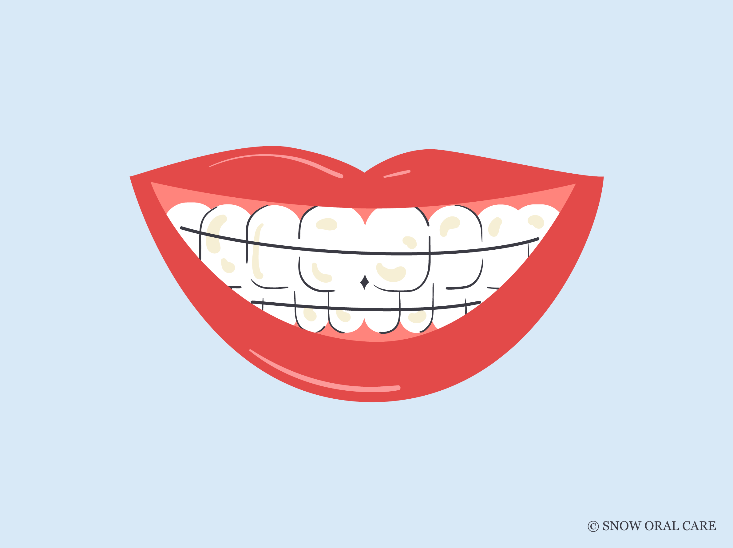 Can a Retainer Stain Your Teeth? | SNOW® Oral Care