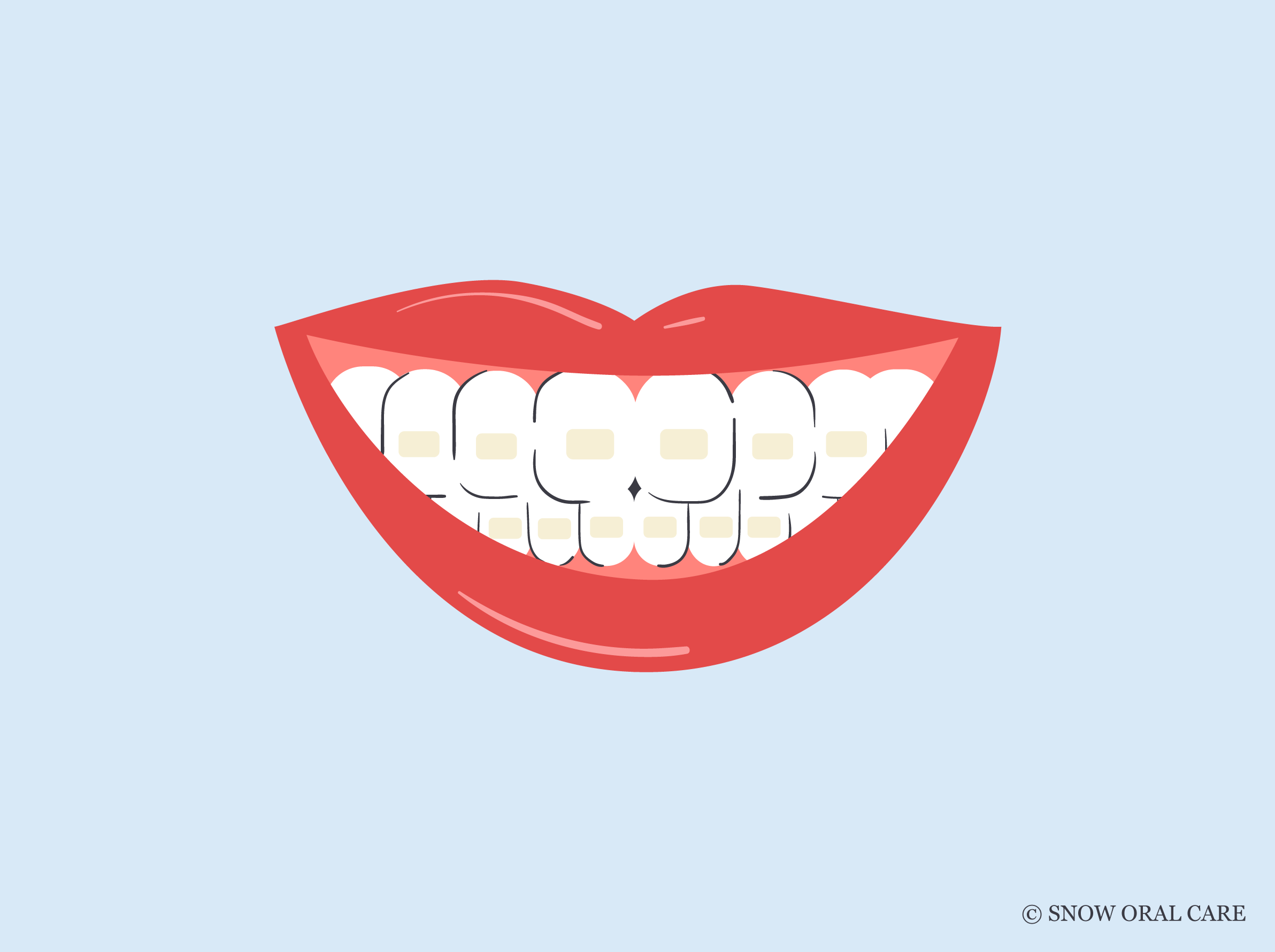 Stained Teeth After Braces | SNOW® Oral Care